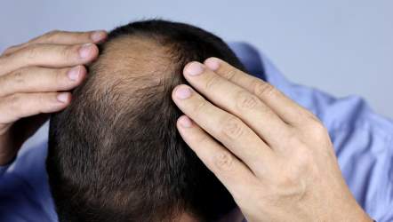 hair loss sings hair loss sings